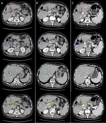 Complete Response to Combined Chemotherapy and Anti-PD-1 Therapy for Recurrent Gallbladder Carcinosarcoma: A Case Report and Literature Review